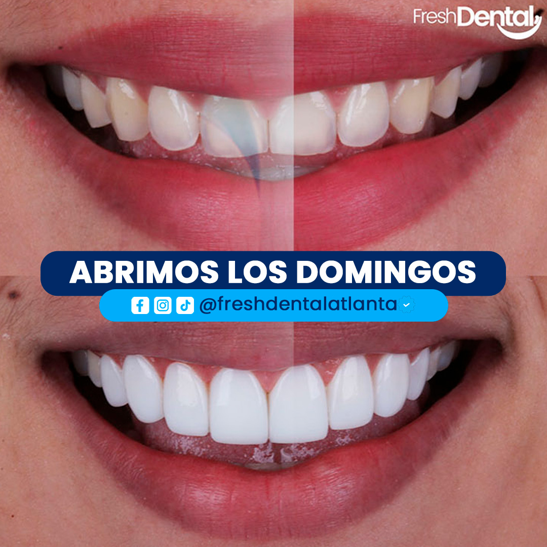 banner-2-blanqueamiento-dental-sonrisa-saludable-fresh-dental-atlanta