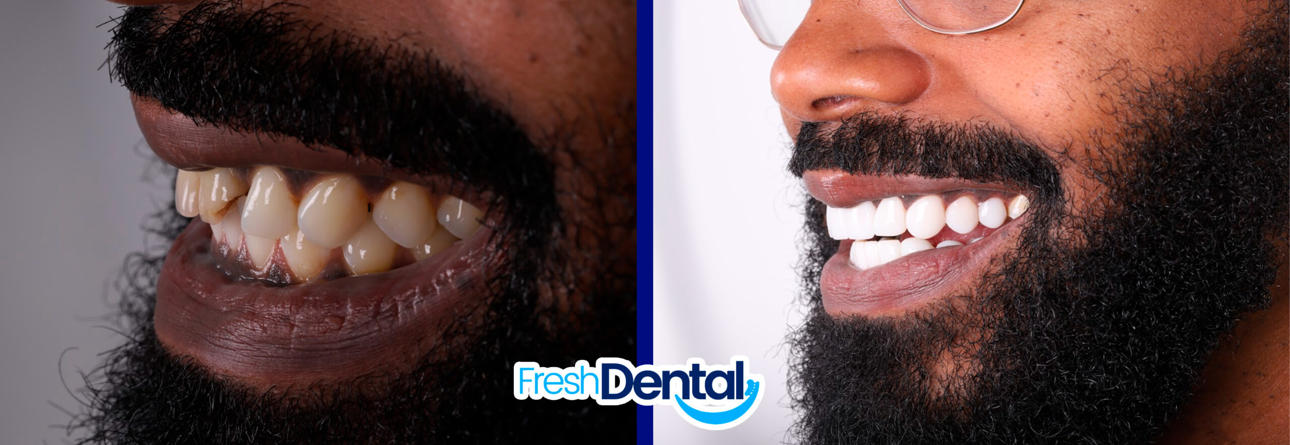 carillas-en-resina-antes-y-depues